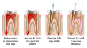 endodonzia_tangorradentista